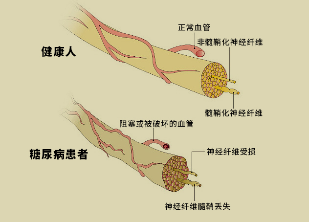 全球每30秒就有人因它截肢！糖尿病怎么改善和预防？